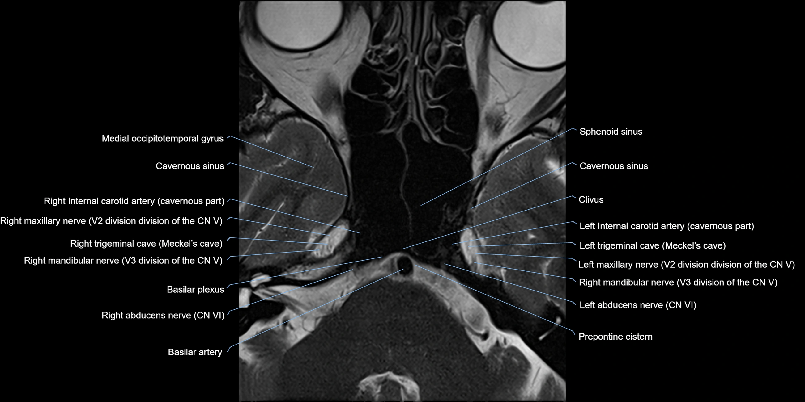 MRI cavernous sinus axial cross sectional 3T anatomy image-img-11001-00006.webp